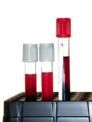 three hemolyzed blood samples