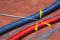 Needle Piercing Nerve